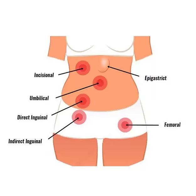 HIATAL-HERNIA