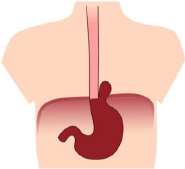 Hiatus Hernia