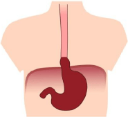 Hiatus Hernia