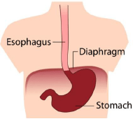 Hiatus Hernia