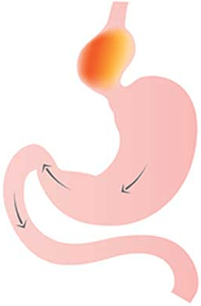 Hiatus Hernia