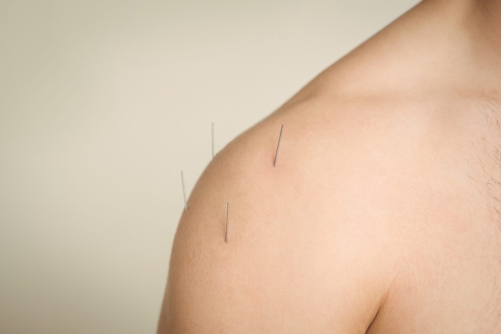 Dry Needling Treatment in cincinnati