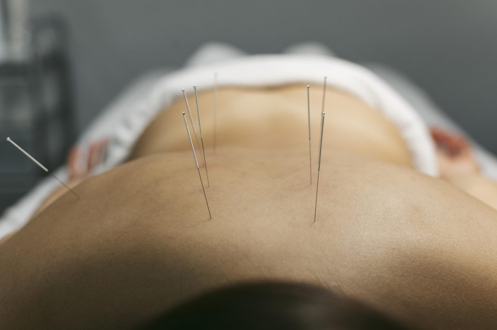 Dry Needling in Cincinnati