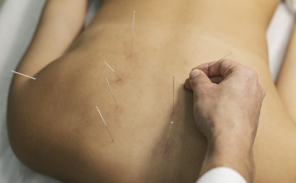 Dry Needling Cincinnati