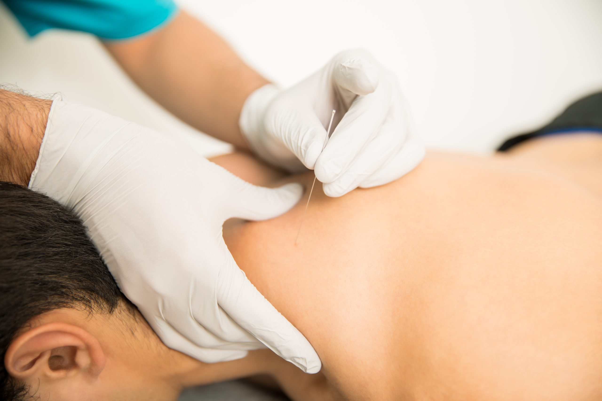 Dry Needling Cincinnati